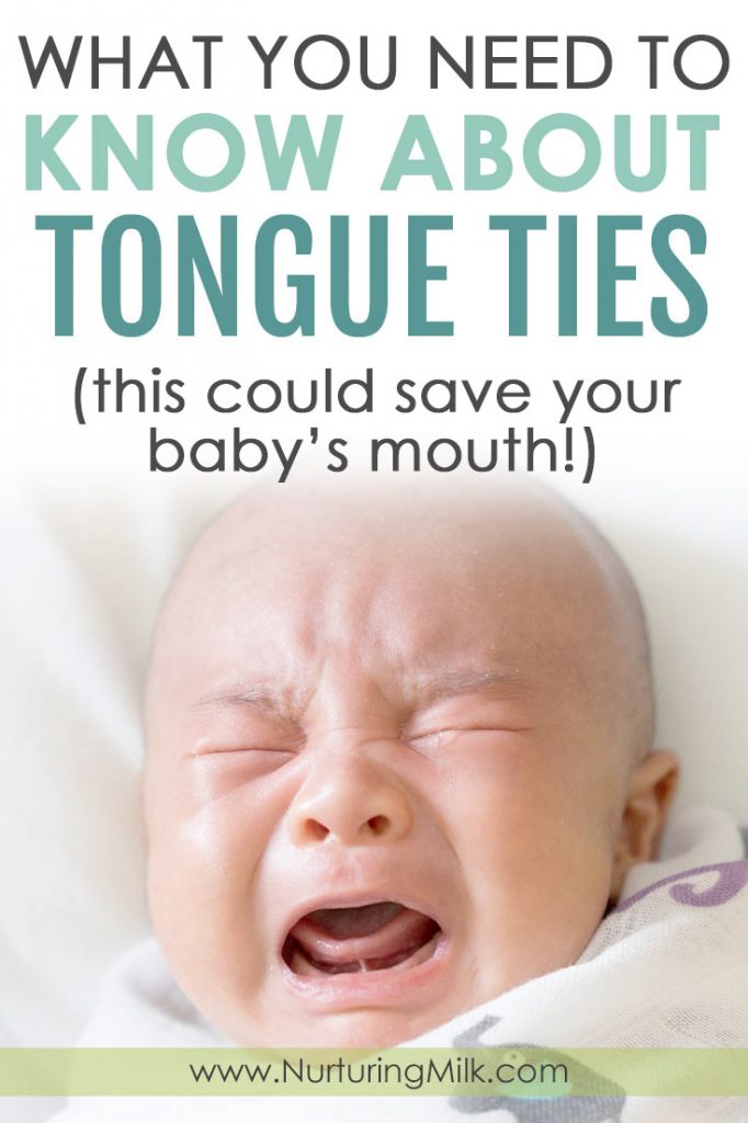 What you need to know about tongue ties