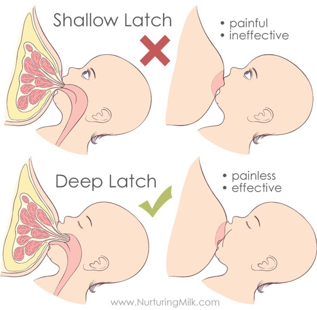 Differences between a shallow latch and a deep latch. Shallow latches are known for causing nipple pain. You can heal sore nipples by adjusting latch.