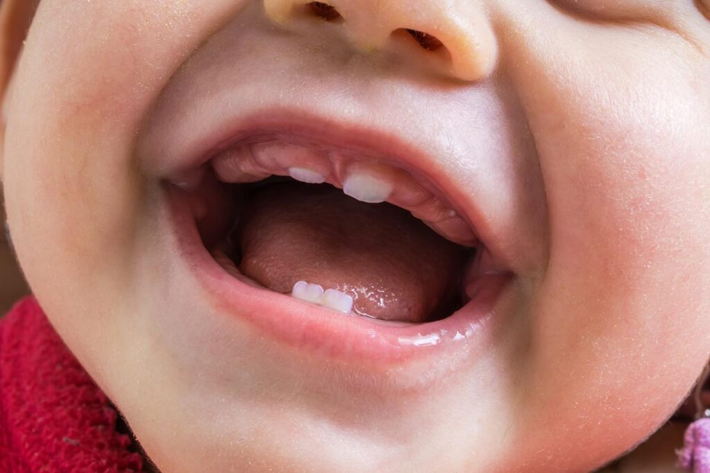 Upper lip ties usually accompany tongue ties and can leave a gap in the upper front teeth