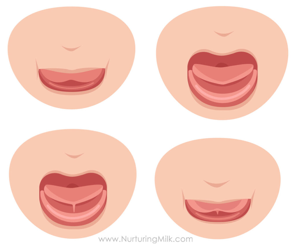 Not all tongue ties are obvious or visible