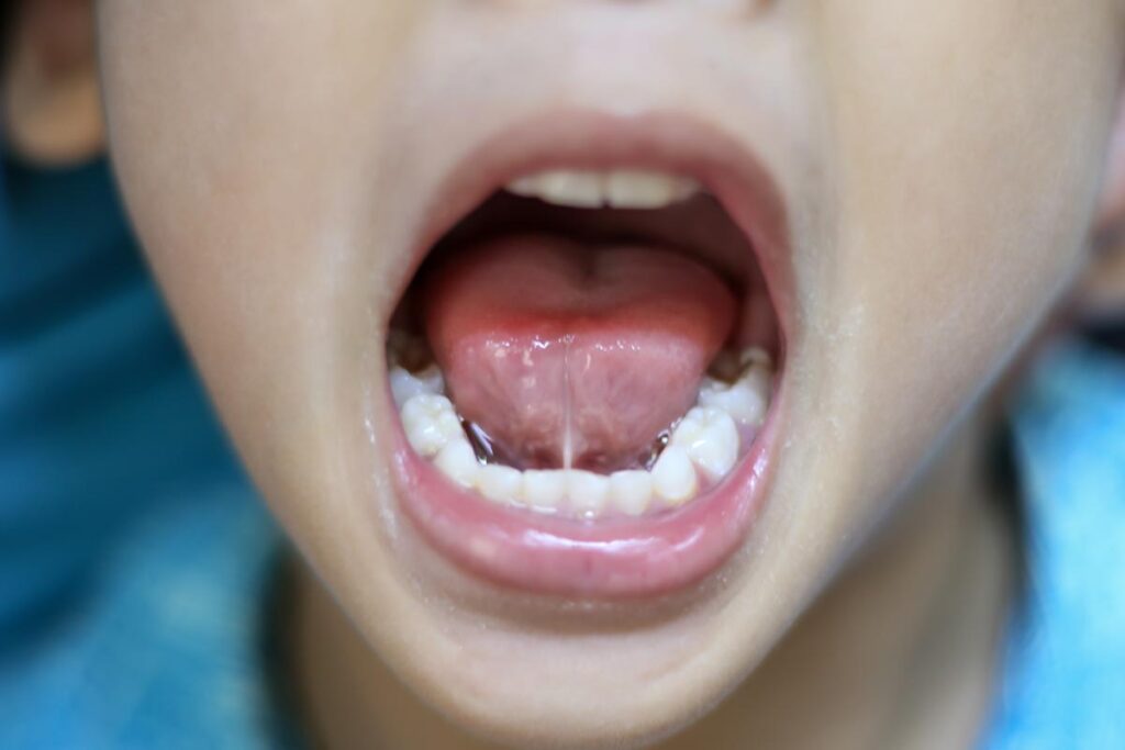 An older child who cannot elevate the tongue due to being tied