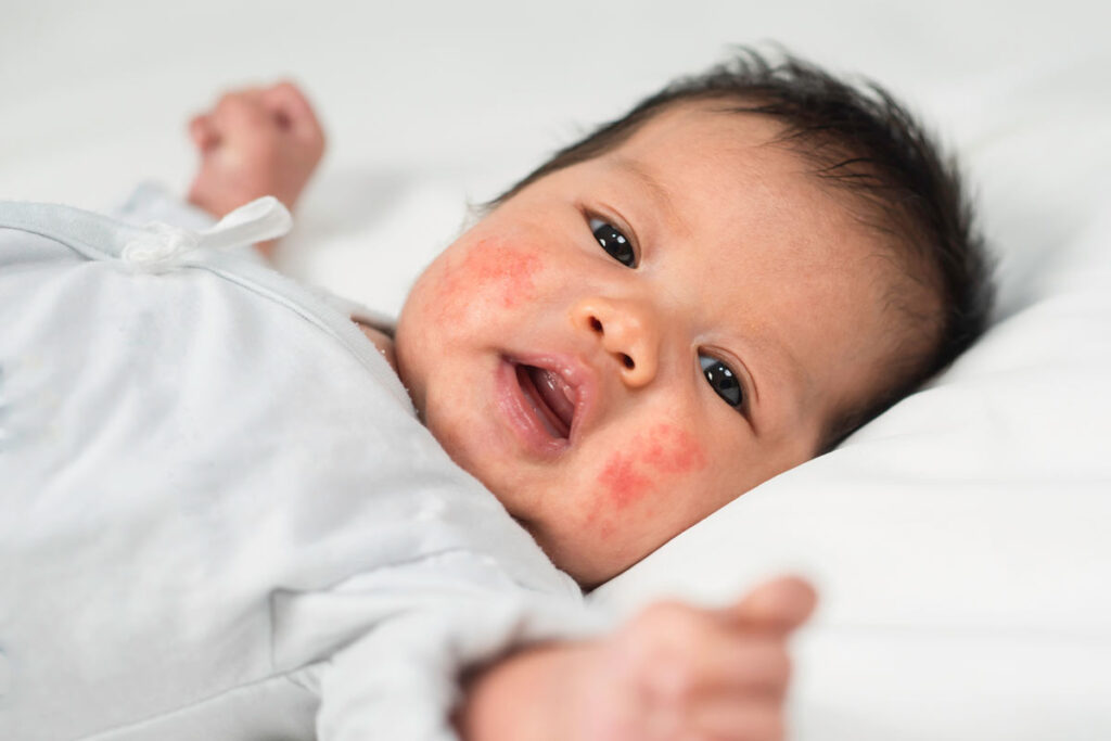 Baby with dairy rash on his cheeks